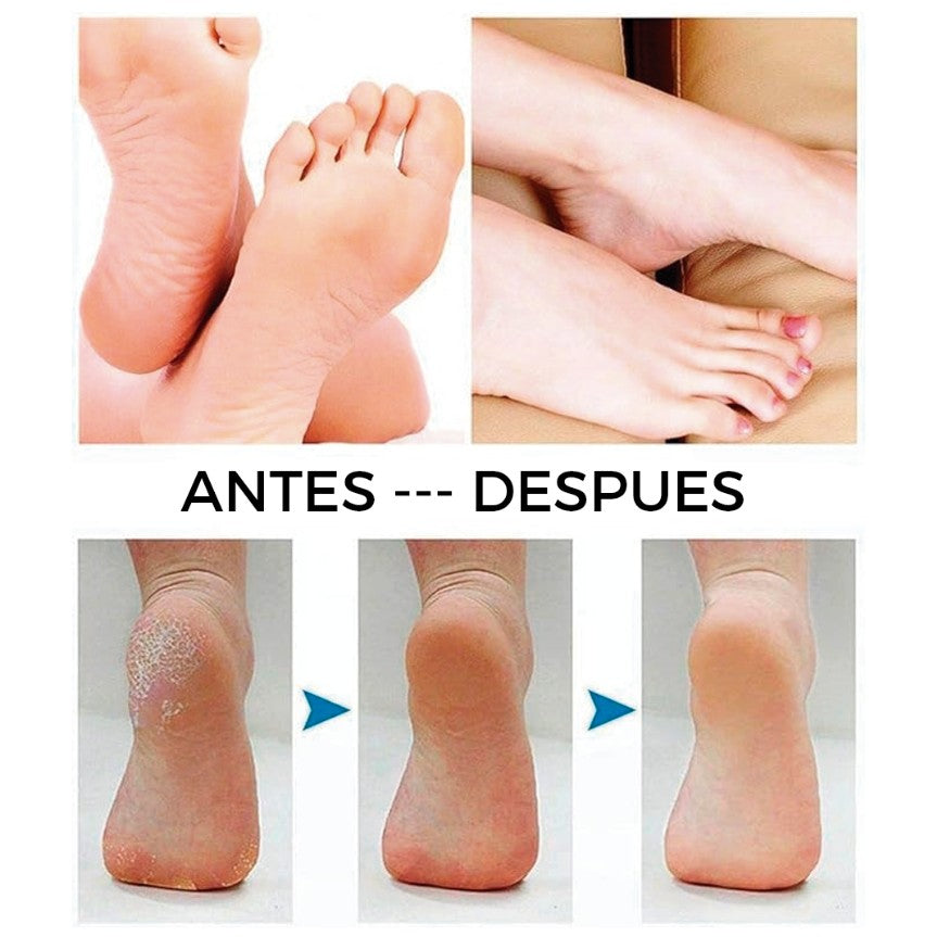Exfoliante De Pies y Removedor de Durezas